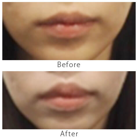 上唇小帯切除術1