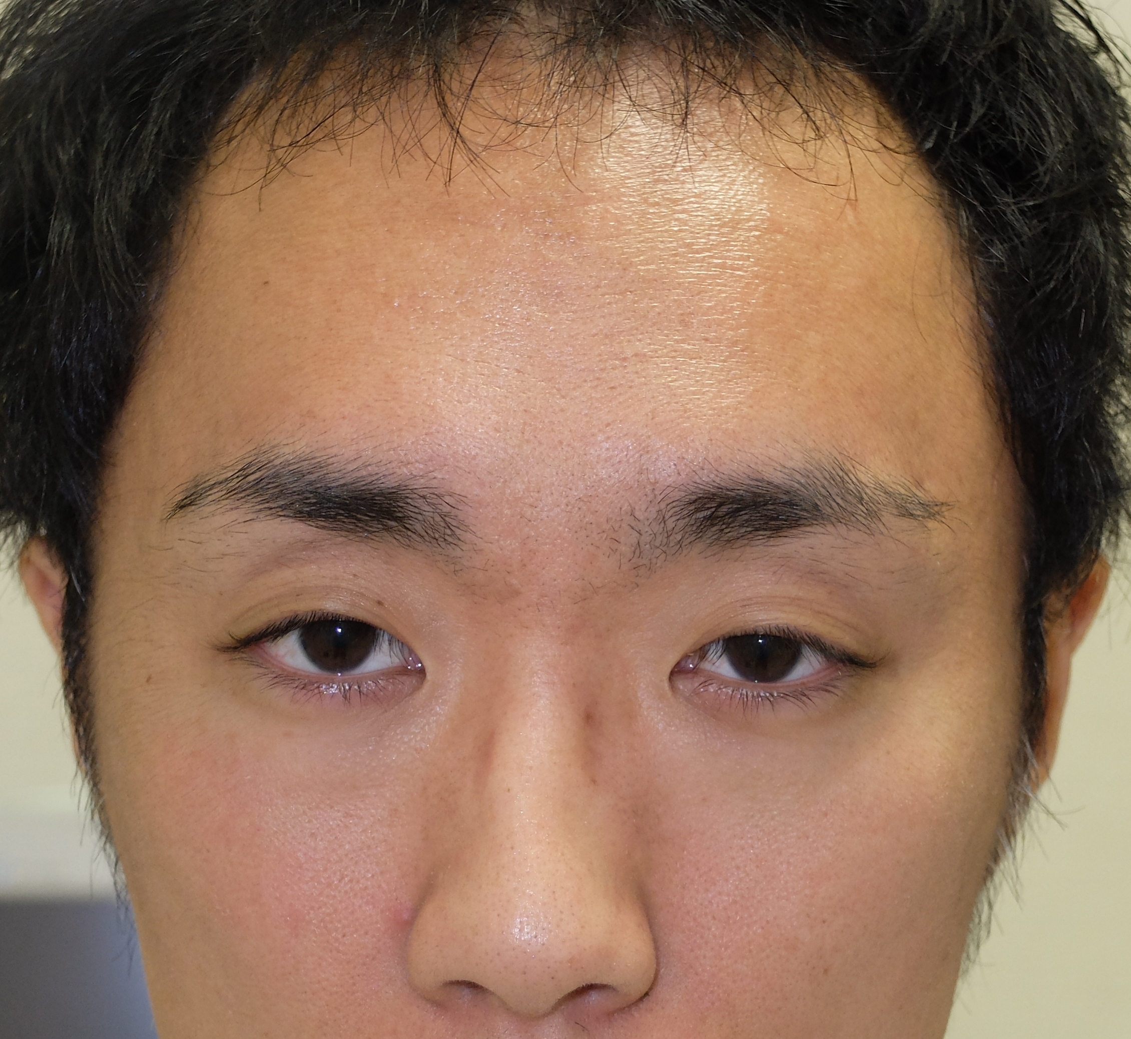 眼瞼下垂の術後変化～若年男性の眼瞼下垂～ - 美容・形成外科医 中村優のブログ