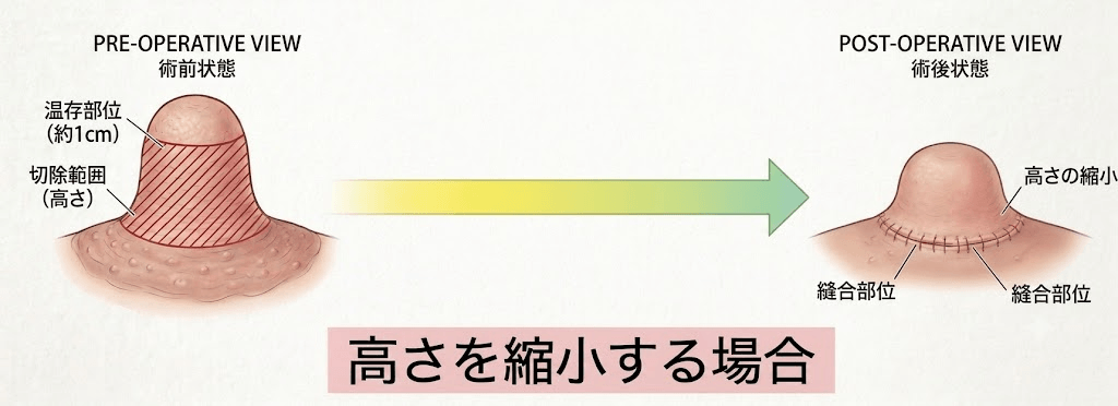 乳頭の高さを縮小する方法