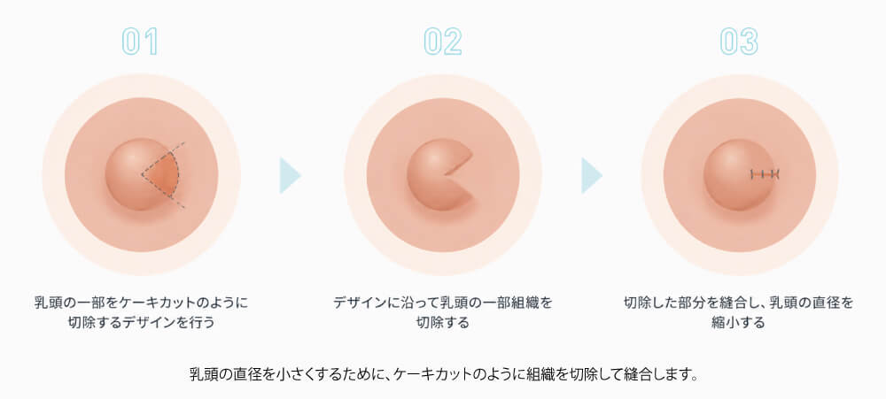 nipple_reduction_02