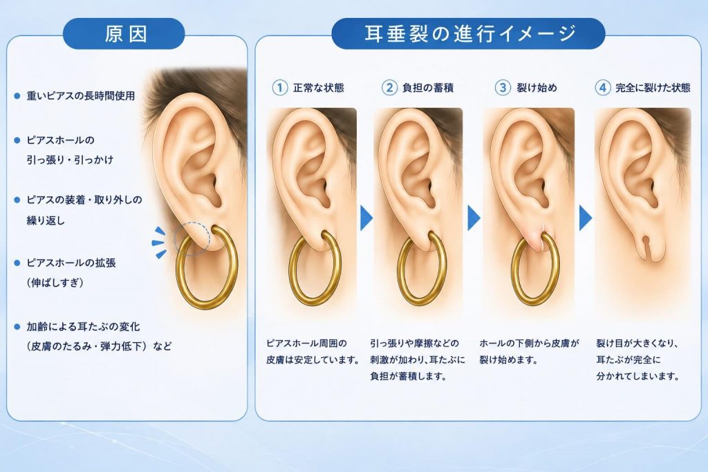 耳たぶが裂けてしまった状態