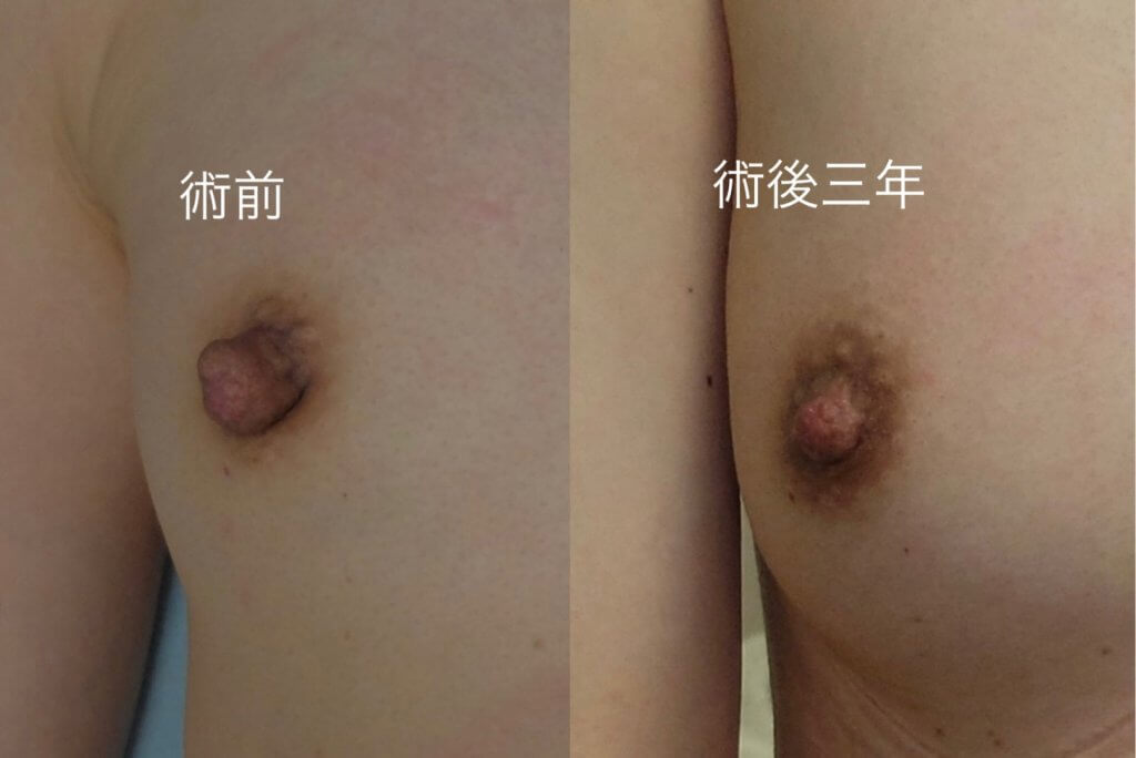 乳首 東京美容外科