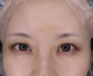 切らない眼瞼下垂症手術　LT法2点　1か月までの経過