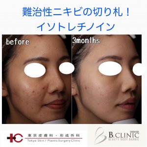 ニキビ治療薬イソトレチノイン(アクネトレント)の効力