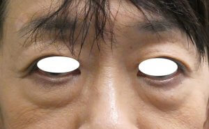 切開ハムラ法の経過です。①