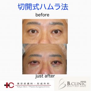 切開式ハムラ法②　術直後