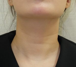 ベビーコラーゲンブースター　7年越しの経過