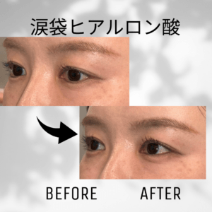 白黒　シンプル　ビフォーアフター　インスタグラムの投稿　正方形 - 1