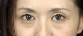 上まぶたの凹みにヒアル注入治療 Sunken Eyeとは 銀座 日本橋院 東京皮膚科 形成外科 奥野公成 超皮膚科学