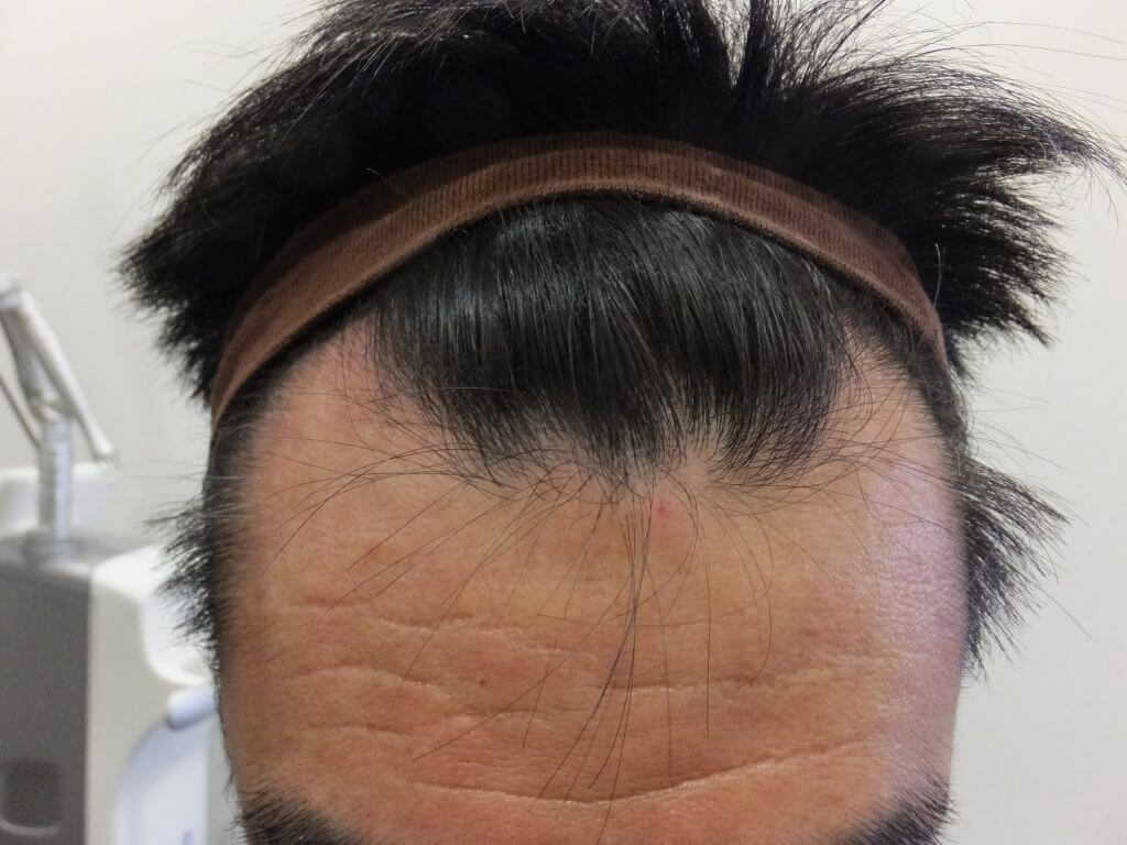 女性薄毛と男性型脱毛症（AGA）の各種治療説明 東京皮膚科・形成外科 奥野公成 超皮膚科学