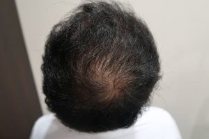 AGA・女性薄毛にPRP（多血小板血漿）注入で育毛治療