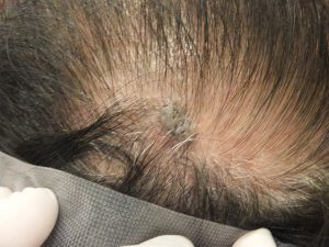 頭のイボを取ってもそこにはまた毛が生える 東京皮膚科 形成外科 奥野公成 超皮膚科学