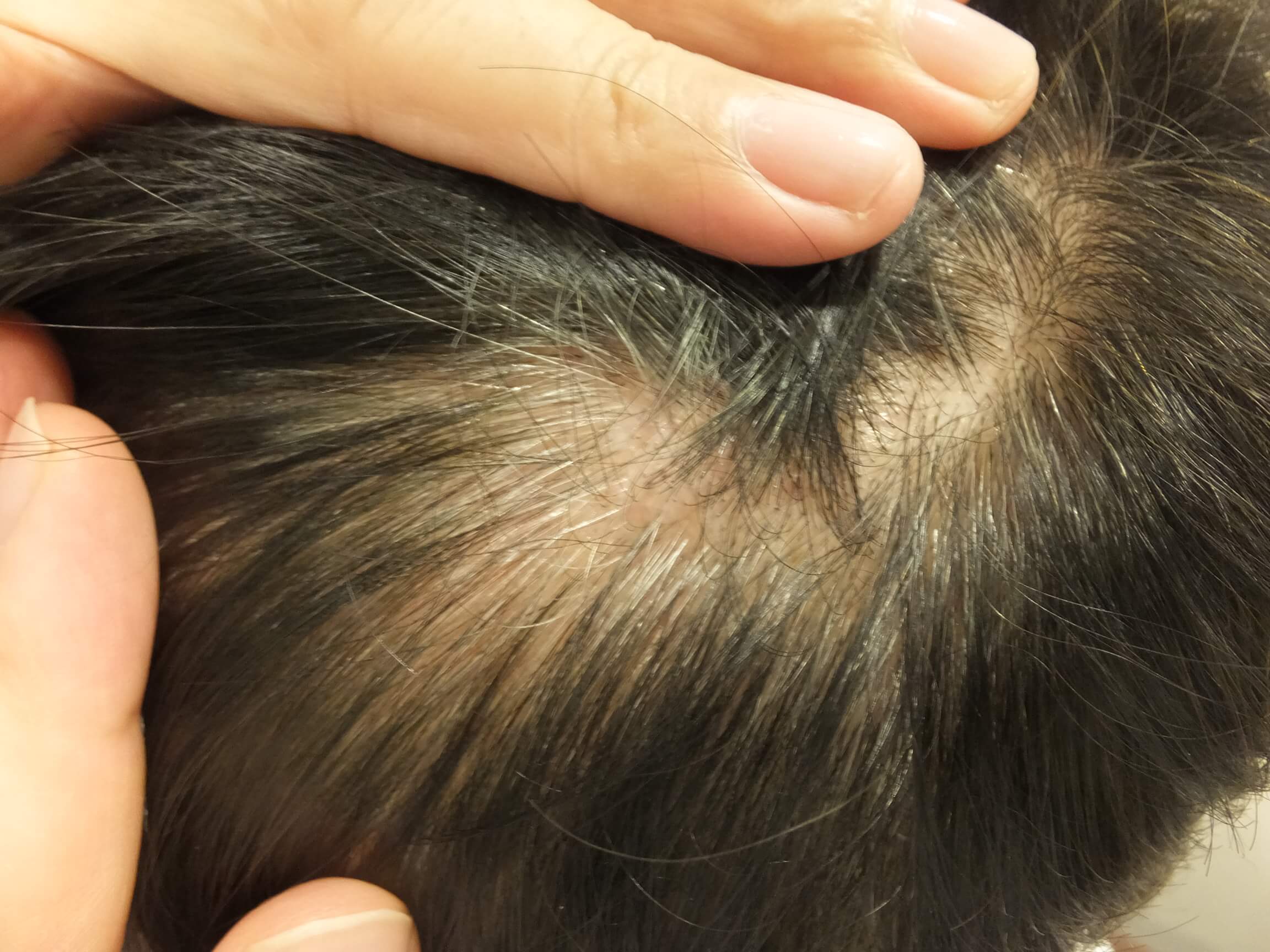 頭のイボを取ってもそこにはまた毛が生える 東京皮膚科 形成外科 奥野公成 超皮膚科学