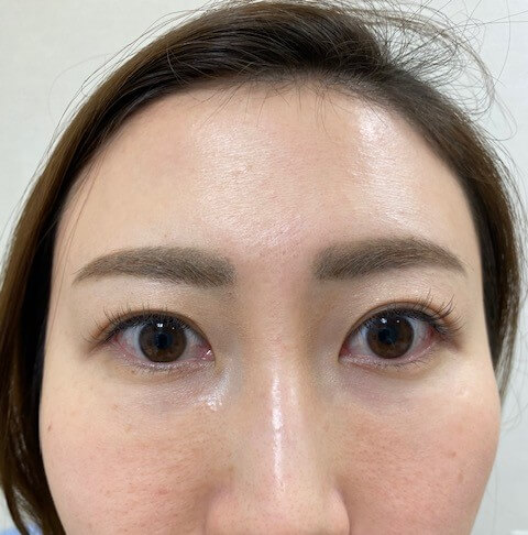 皮膚科専門医による施術 目の下のしわを消す 東京皮膚科 形成外科 奥野公成 超皮膚科学