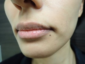 【皮膚科専門医による施術】唇のホクロ・しみ治療